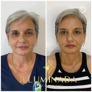 antesdepois07