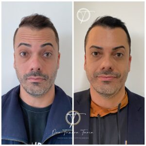 antesdepois05