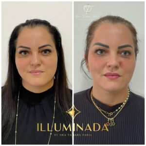 antesdepois04