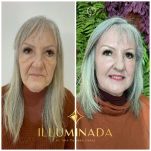 antesdepois02